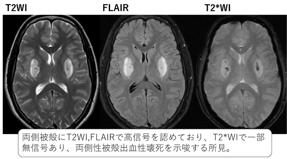 メタノール中毒のMRI画像所見のポイント
